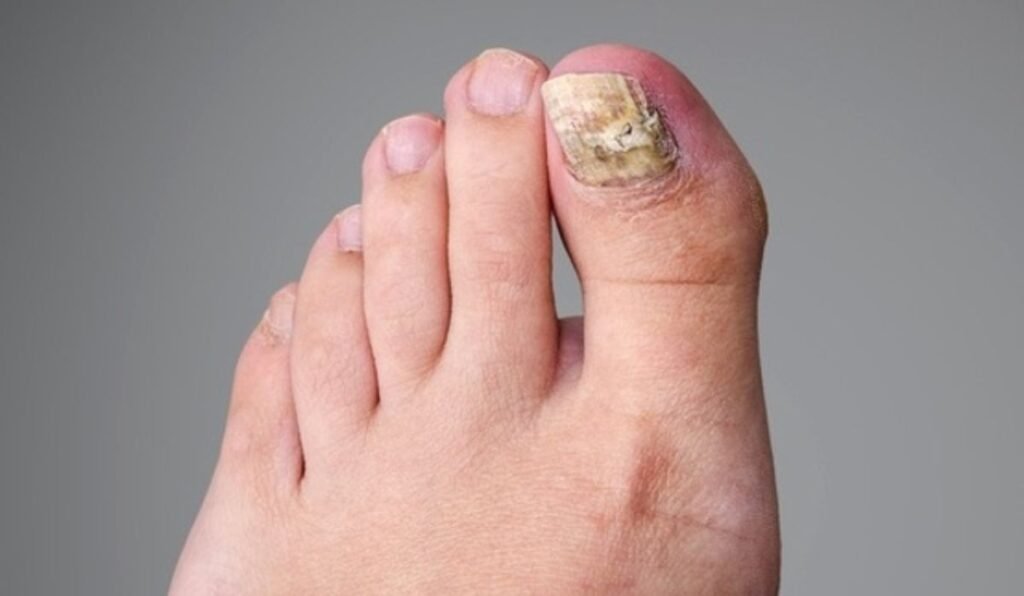 kerassentials for toenail fungus