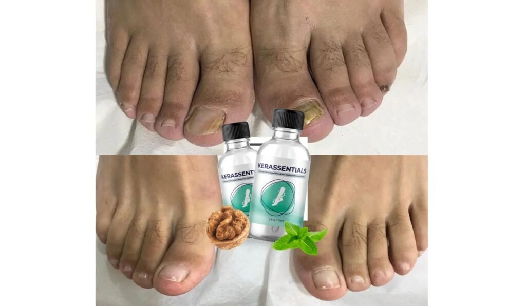 kerassentials for toenail fungus