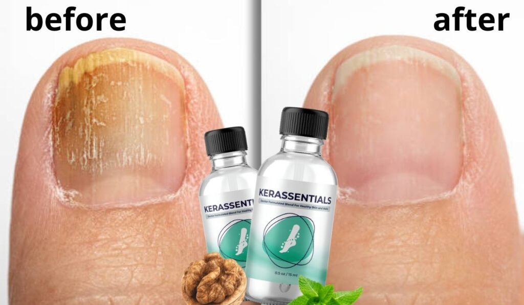 kerassentials oil: how I got rid of nail fungus for good